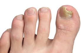 Nail & Fungal Infections Treatment